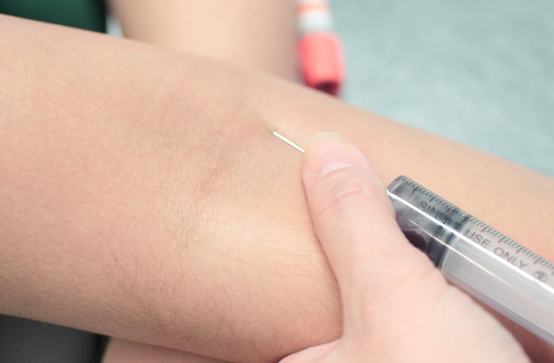 Researchers report increased TB vaccine effectiveness when injected directly into the bloodstream instead of the skin. Image via Medical News.
